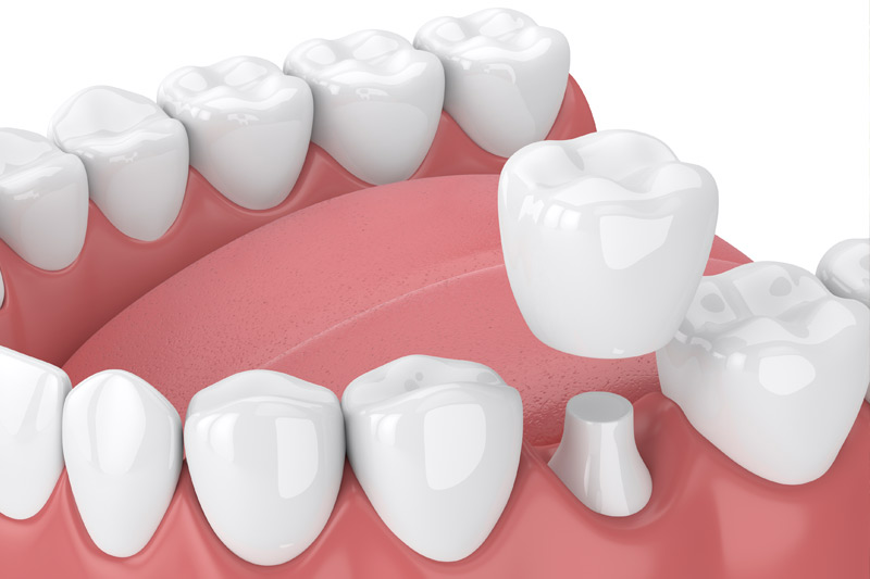 Dental Crowns in Miami