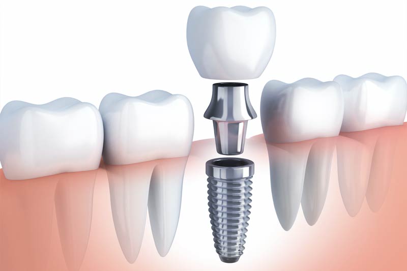 Implants Dentist in Miami