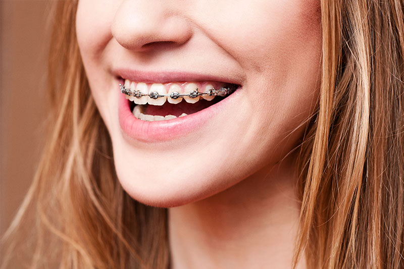 Orthodontics in Miami